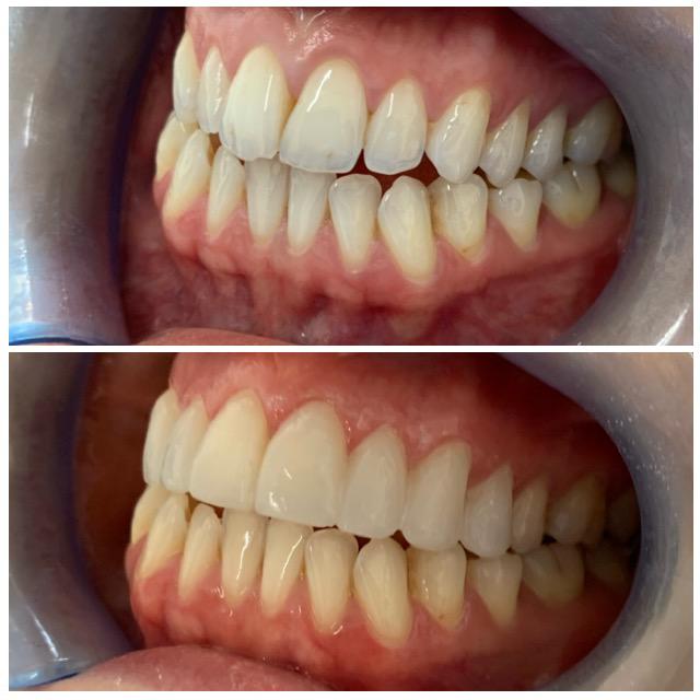 Discoloration and staining of teeth can occur over time.