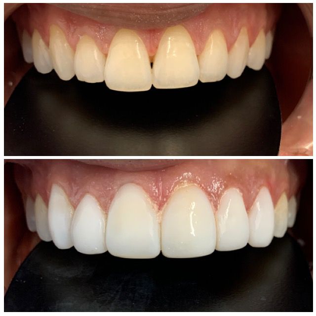 Say Goodbye to Imperfections with Composite Bonding at DHA